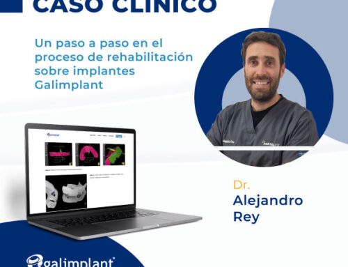 Caso clínico | Un paso a paso en el proceso de rehabilitación sobre implantes Galimplant